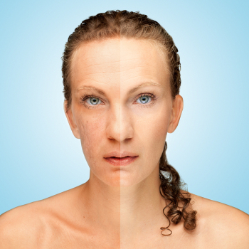 Photoaging